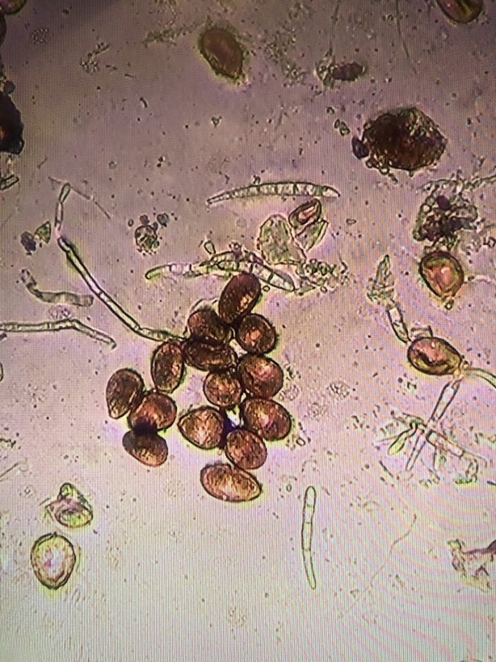 Baseball bat-shaped spores of Cercospora zea-maydis, fungal pathogen that causes of Gray Leaf Spot intermixed with teardrop-shaped spores of Puccinia polysora, fungal pathogen that causes Southern Rust of corn.